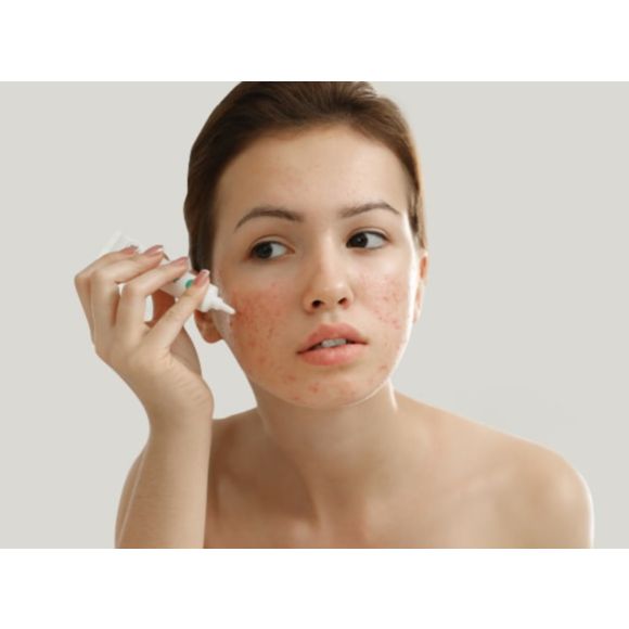 Kobieta z trądzikiem różowatym - tytułowa.