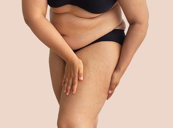Kobieta z cellulitem tłuszczowym na udach