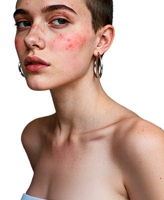 trądzik różowaty.