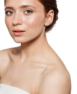 przebarwienia skóry.