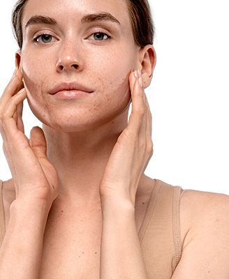 zaskórniki i nadmiar sebum.