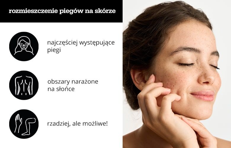 rozmieszczenie piegów na skórze - infografika