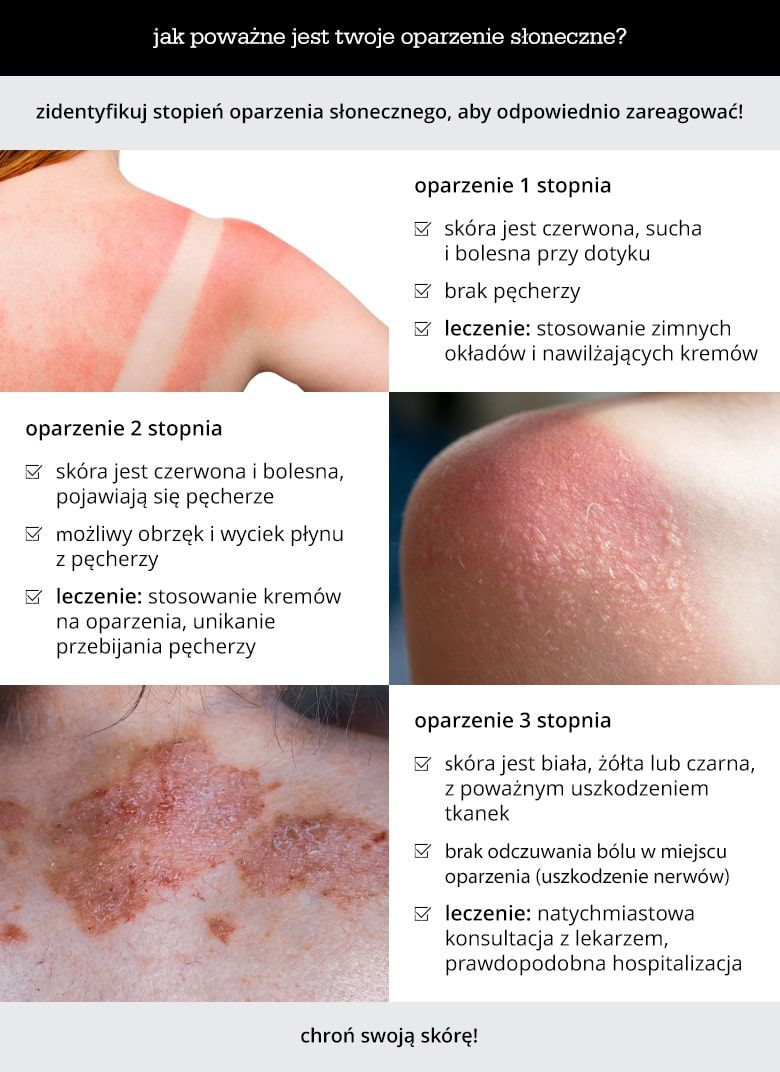 Jak poważne jest twoje oparzenie słoneczne? - infografika