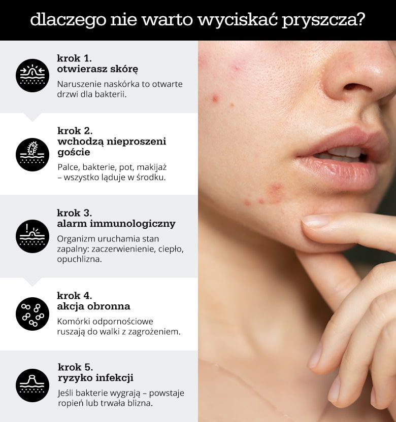 Dlaczego nie warto wyciskać pryszcza - zdjęcie.
