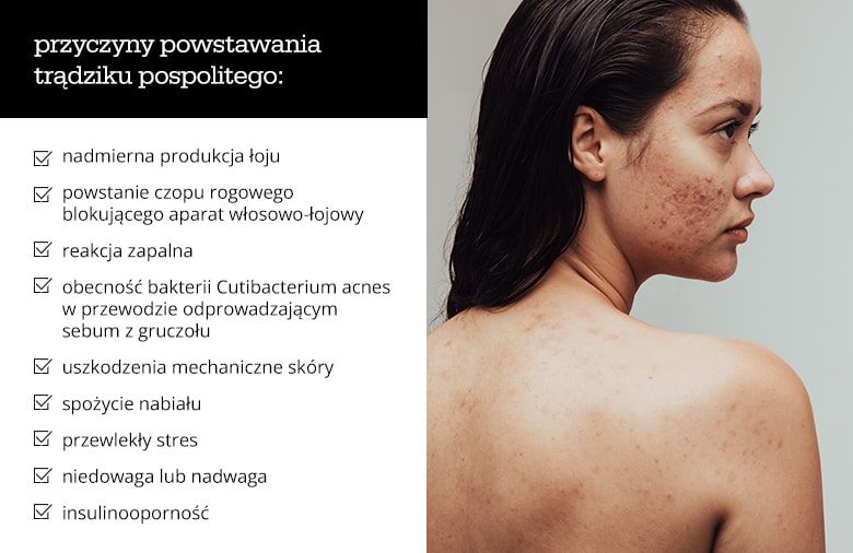 Przyczyny powstawania trądziku pospolitego - infografika