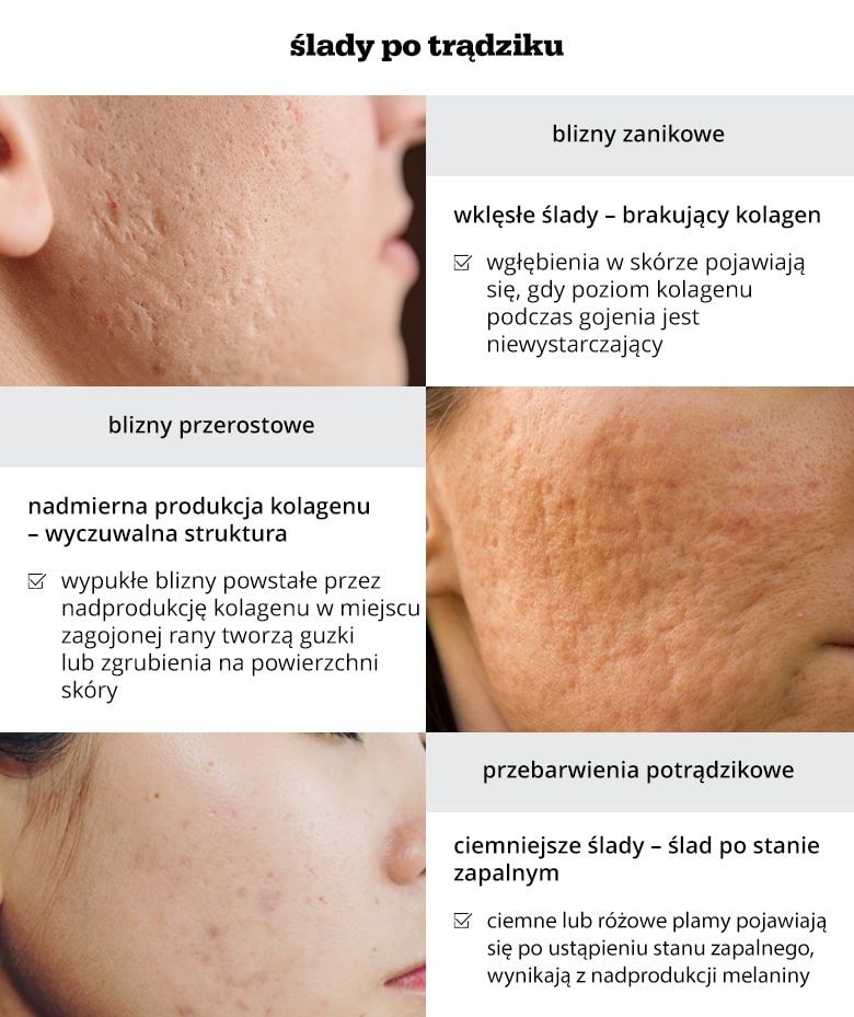 Infografika o śladach potrądzikowych